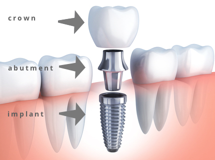Dental Implant presentation image by dr shahzad Hussain in Pakistan